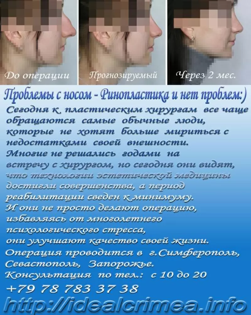 Коррекция формы и размера носа (ринопластика). Крым
